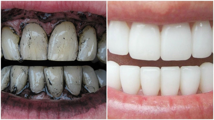 Teeth Whitening Charcoal Powder - 24 Hour Sale Only!