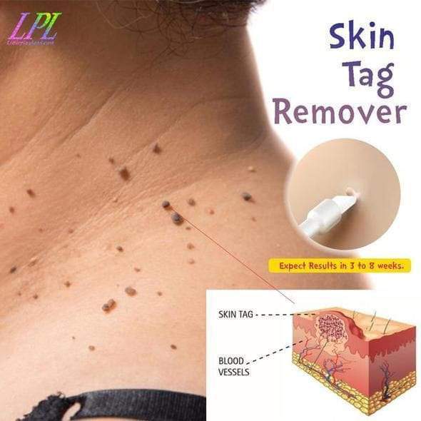 Skin Tag Miracle Oil Remover